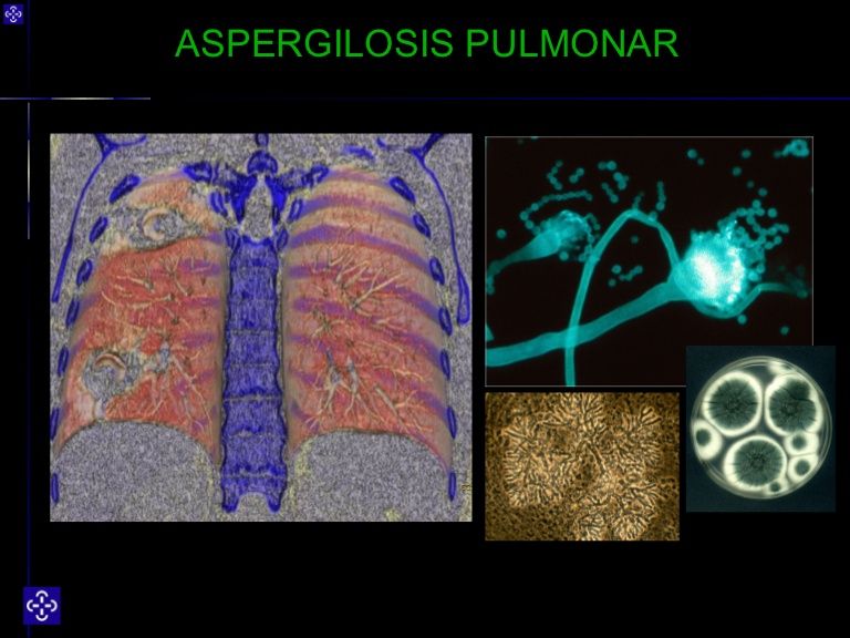 Aspergilosis pulmonar crónica en asociación con tuberculosis activa: reporte de un caso