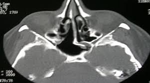 Presión intracraneal por catéter intraparenquimatoso versus diámetro de la vaina del nervio óptico por ultrasonido 