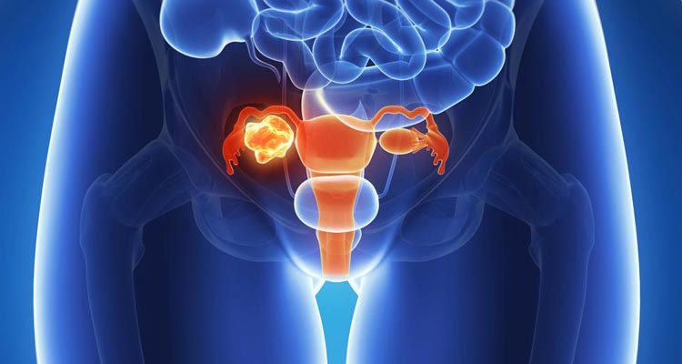 Solo el 25% de los casos de cáncer de ovario se detecta en etapa inicial