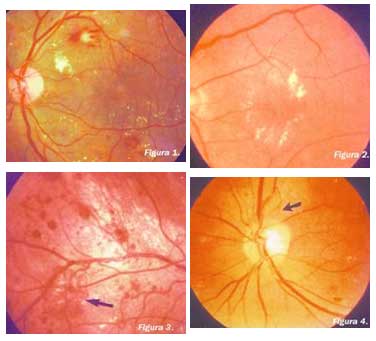 Impacto de los agonistas del GLP-1 y los inhibidores del SGLT-2 en la progresión de la retinopatía diabética: Un estudio de datos agregados de registros electrónicos de salud.